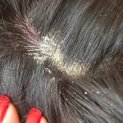 traitement contre le psoriasis du cuir chevelu coupes de traitement contre le psoriasis du cuir chevelu coupes de